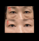 melable U-Therable Lifting 900 Shot Eye Cream 15ml - Image 2