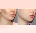 DERMA BUILD Bortide Balloon Ampoule 30ml - Image 2